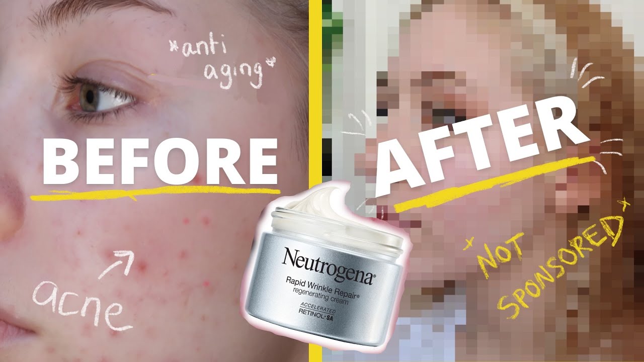 Neutrogena Rapid Wrinkle Repair Review!! *not sponsored* // Retinol for Acne // 3 month progress!
