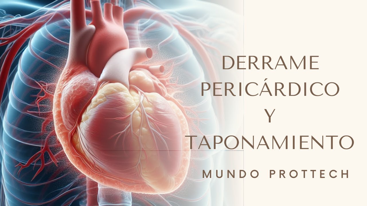 Derrame peric&aacute;rdico y taponamiento card&iacute;aco #derrame #taponamiento #pericarditis
