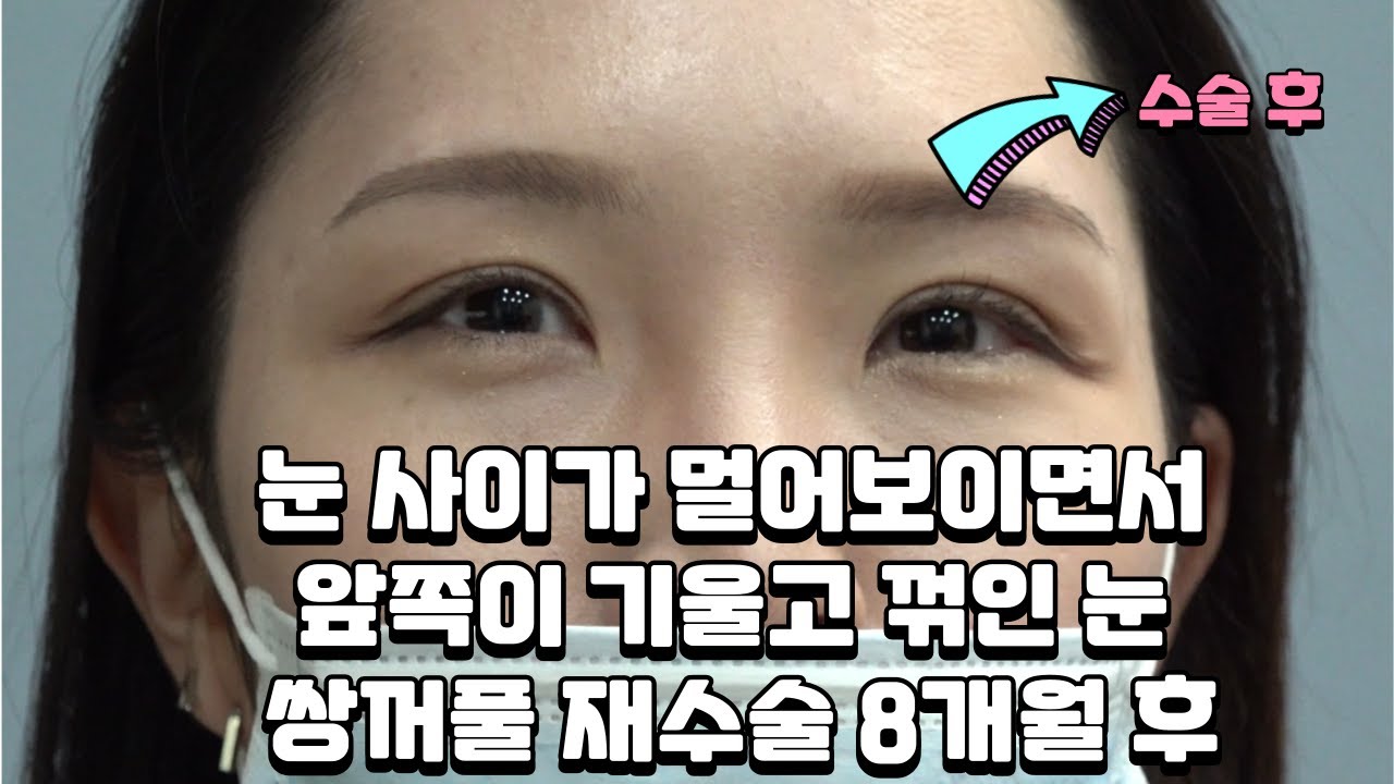 눈 사이가 멀어보이면서 앞쪽이 기울고 꺾인 눈 쌍꺼풀 재수술 8개월 후