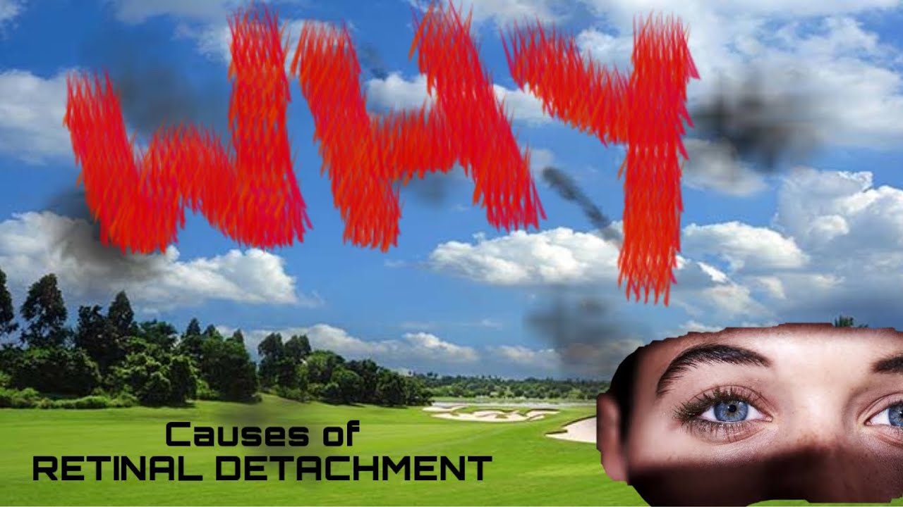 3: Causes of Retinal Detachment /RETINAL DETACHMENT/#retinaldetachment