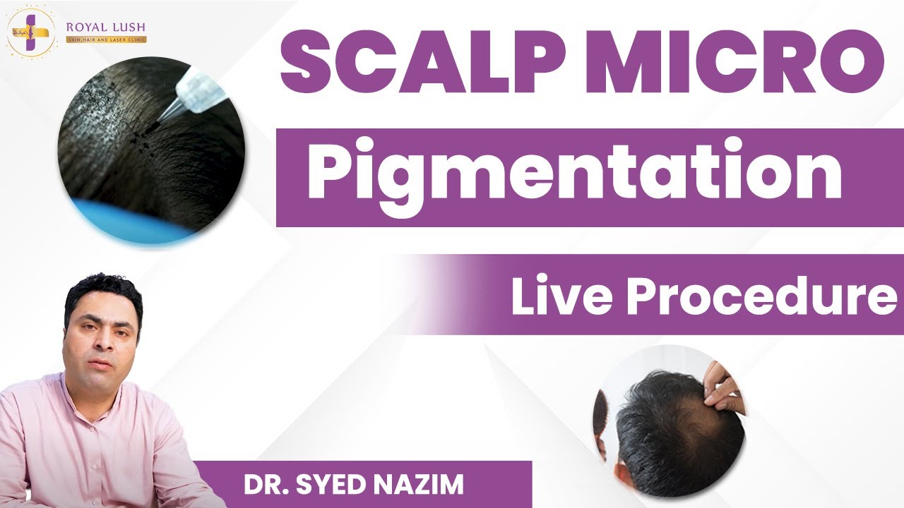 Scalp Micro Pigmentation Live Procedure For Hair Loss | Non Surgical Hair Replacement | SMP Results