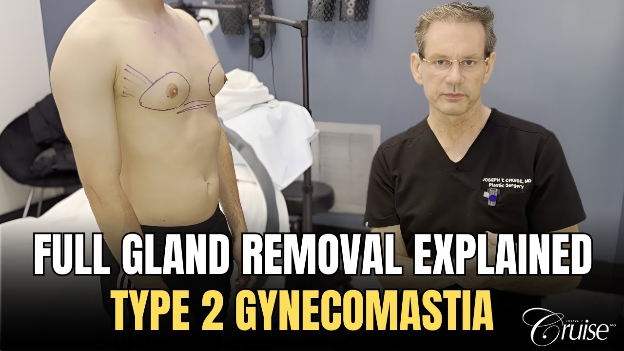 Gynecomastia - When to Remove the Entire Gland vs. Partial Gland