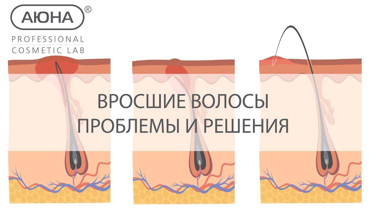 ВРОСШИЕ ВОЛОСЫ, проблемы и решения. Шугаринг и дерматология. Псевдофолликулит, гиперкератоз, рубцы.