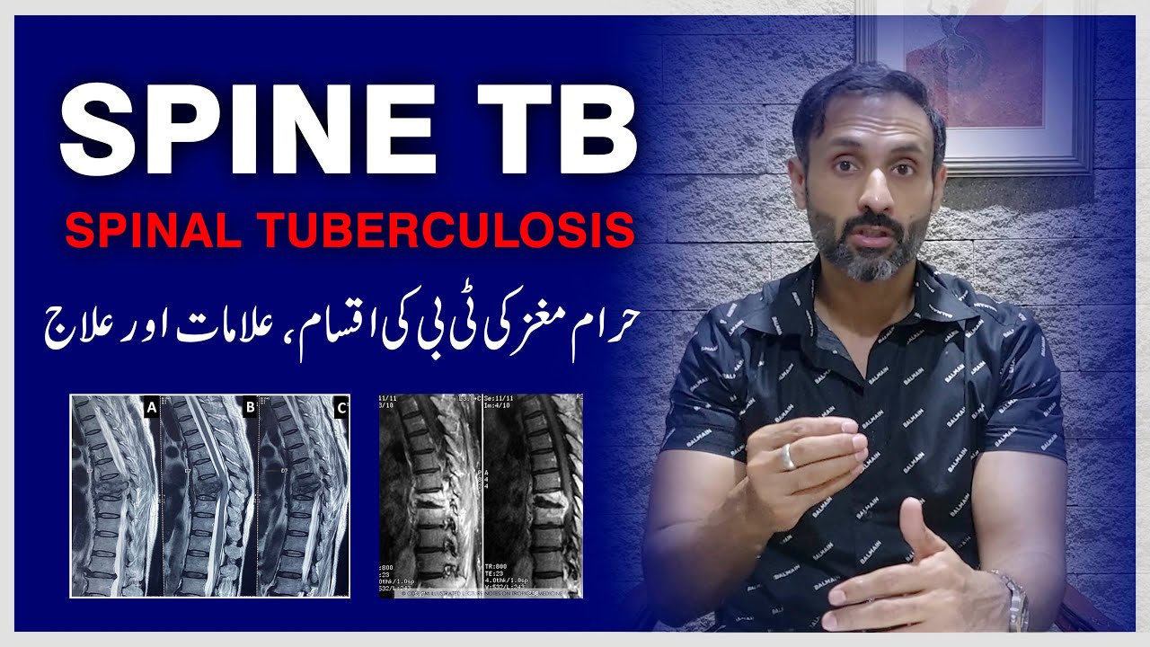 What is Spine Tuberculosis (TB) ? Types, Symptoms and Treatment |  حرام مغز کی ٹی بی کیا ہے؟