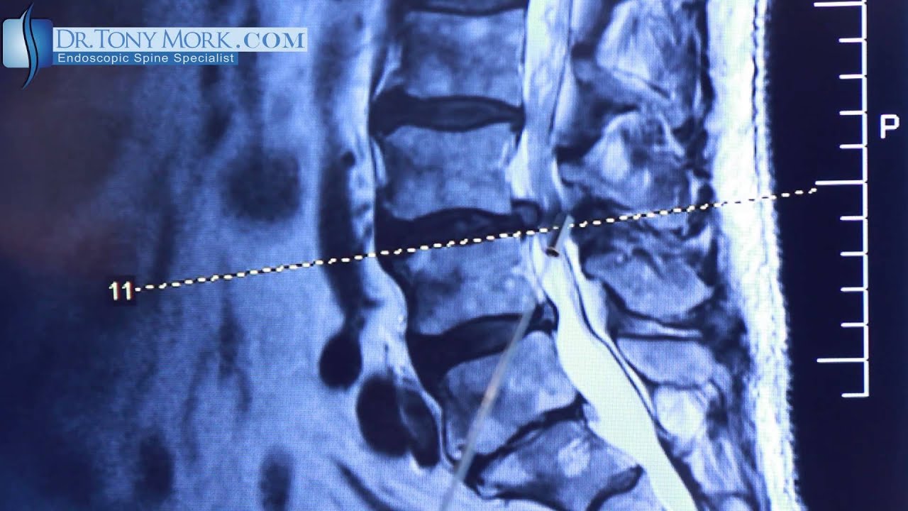 Discectomy vs Laminotomy by Dr. Tony Mork