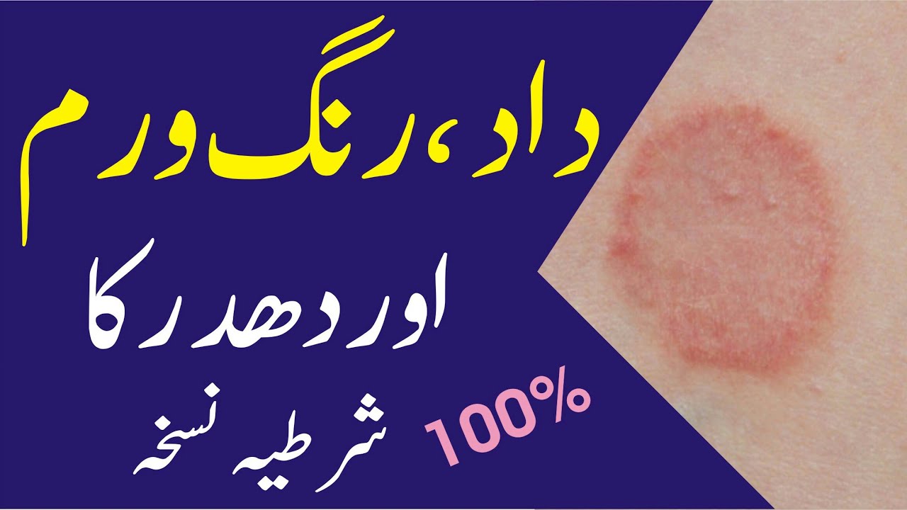 Ringworm dad fungal infection ya dhadri ka ilaj in Urdu hindi.