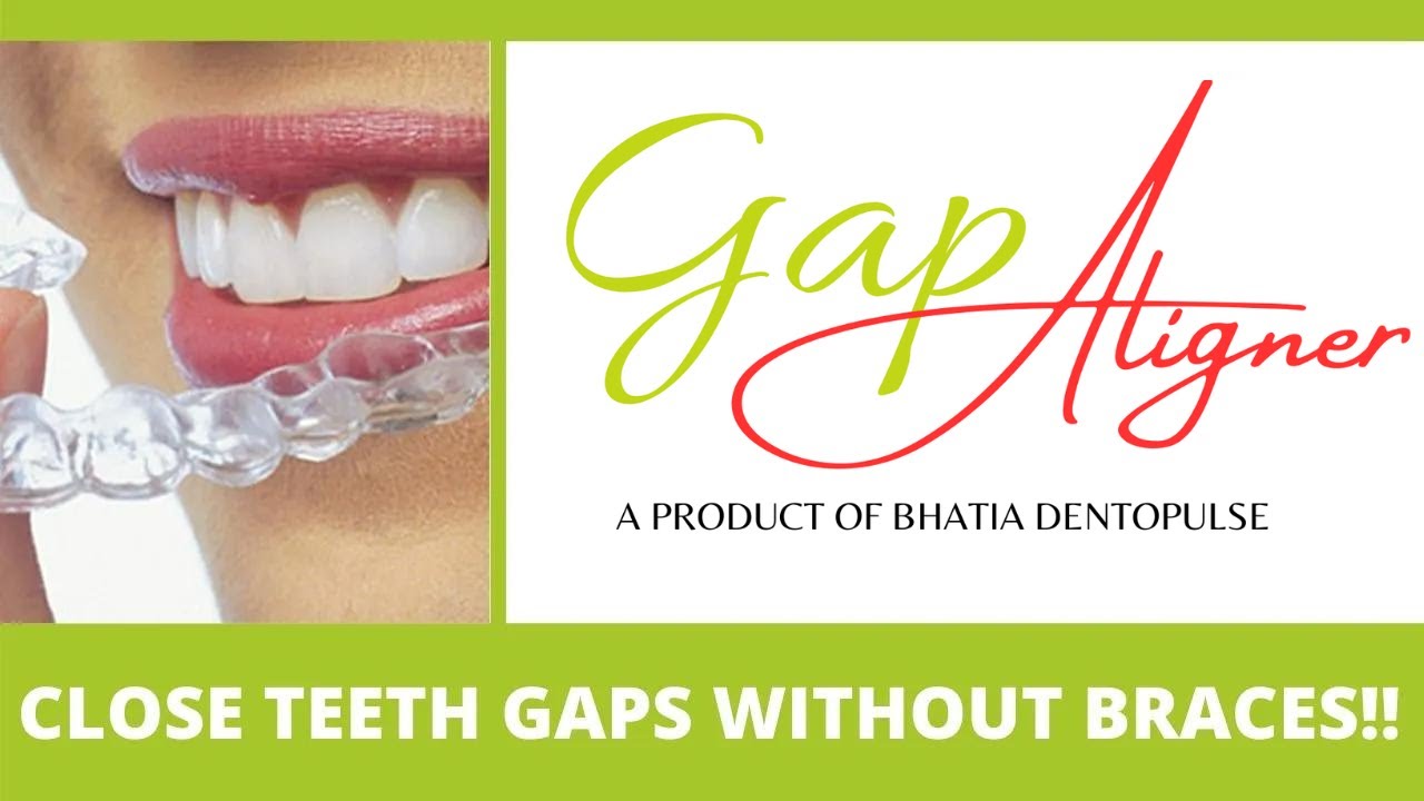 GapAligner: Close Teeth Gaps WITHOUT BRACES at Home!! बिना ब्रेसेस - गैप अलाइनर! Dr. Srishti Bhatia