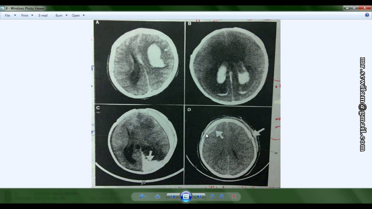 شرح الأشعة المقطعية على الرأس CT scan, Head د. محمود سويلم