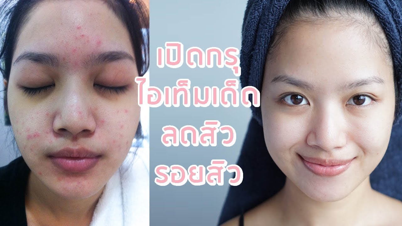 เปิดกรุสกินแคร์ ลดสิว รอยสิว หน้าใส ♡ รักษาสิวด้วยตัวเอง คัดตัวเด็ดๆมาให้แล้ว | ChanyaChannel