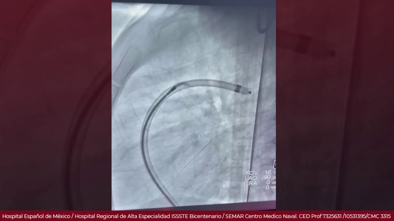 Cierre de persistencia de conducto arterioso con Amplatzer