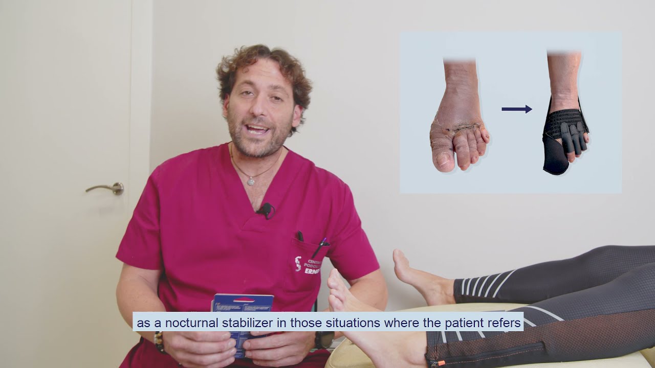 Fixtoe Qx - Estabilizador post-quirúrgico de juanetes y dedos menores