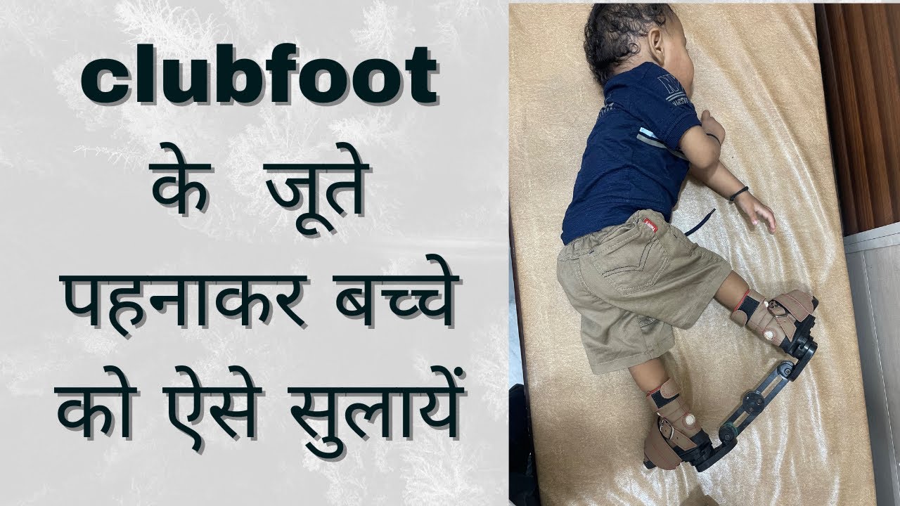 clubfoot जूते पहनकर बच्चे को कैसे सुलाये ?
