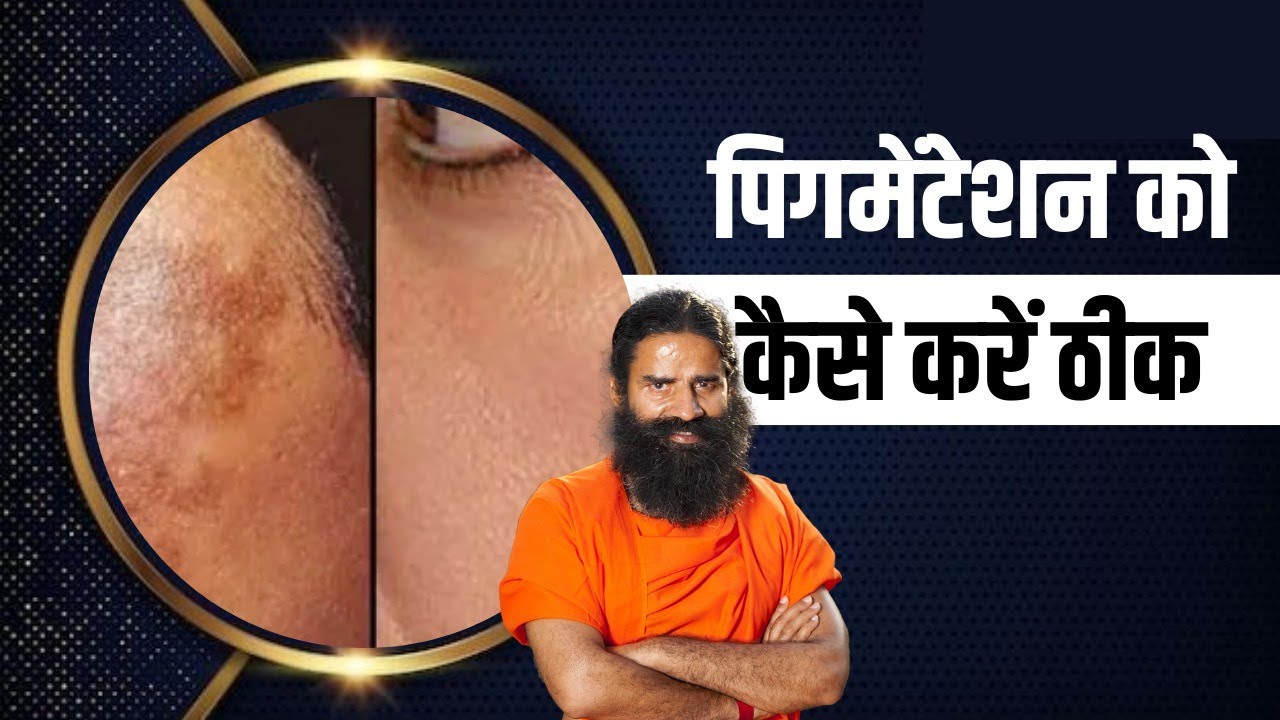 पिगमेंटेशन (Pigmentation) को कैसे करें ठीक || Swami Ramdev
