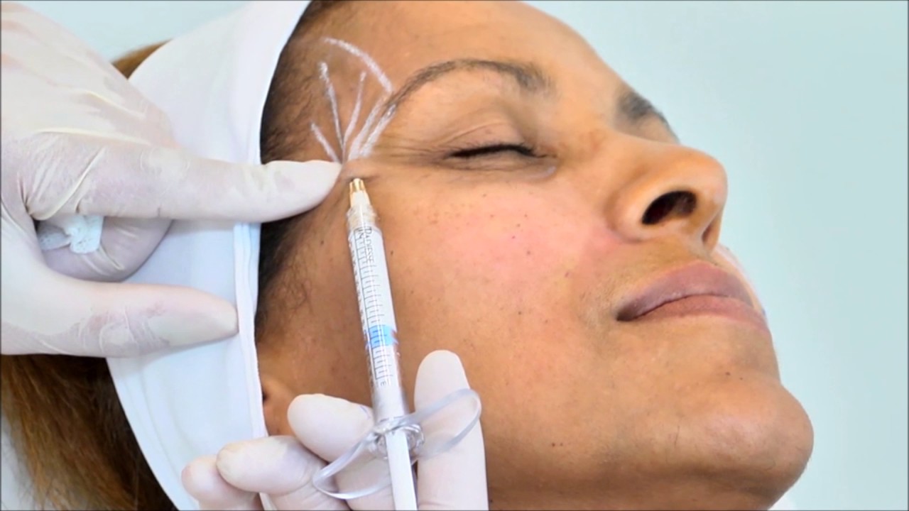Dr Laurent Dumas - Comblement des tempes creuses par injections de Radiesse