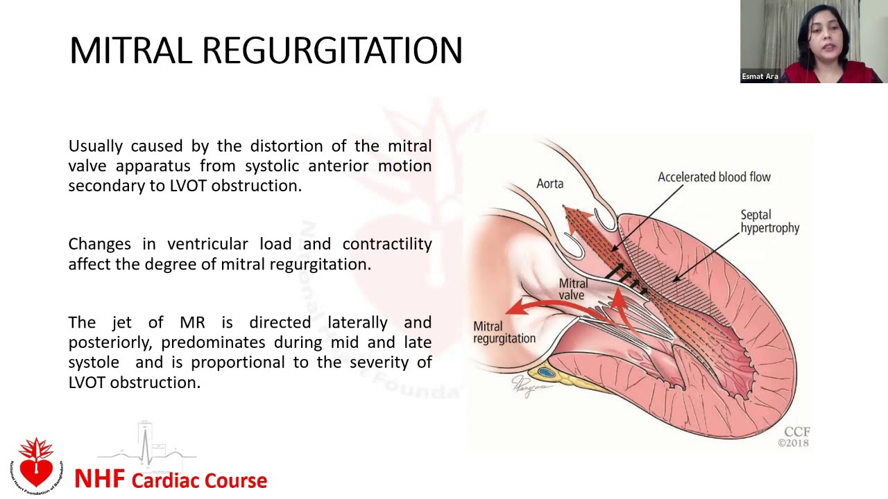 NHF Cardiac Course: Lecture on Cardiomyopathy (HCM & RCM).