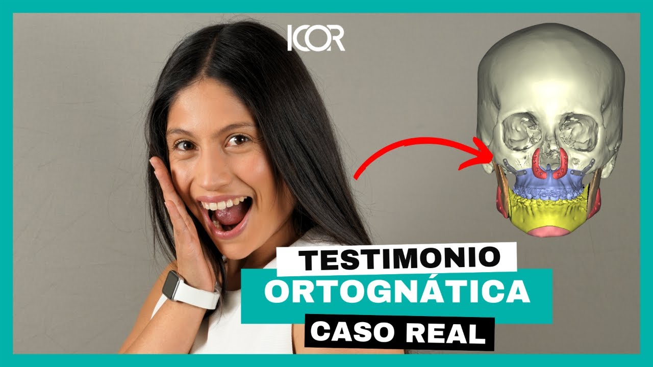 Mi testimonio de cirugía ortognática (Clase II, Implantes, Ortodoncia) - ICOR