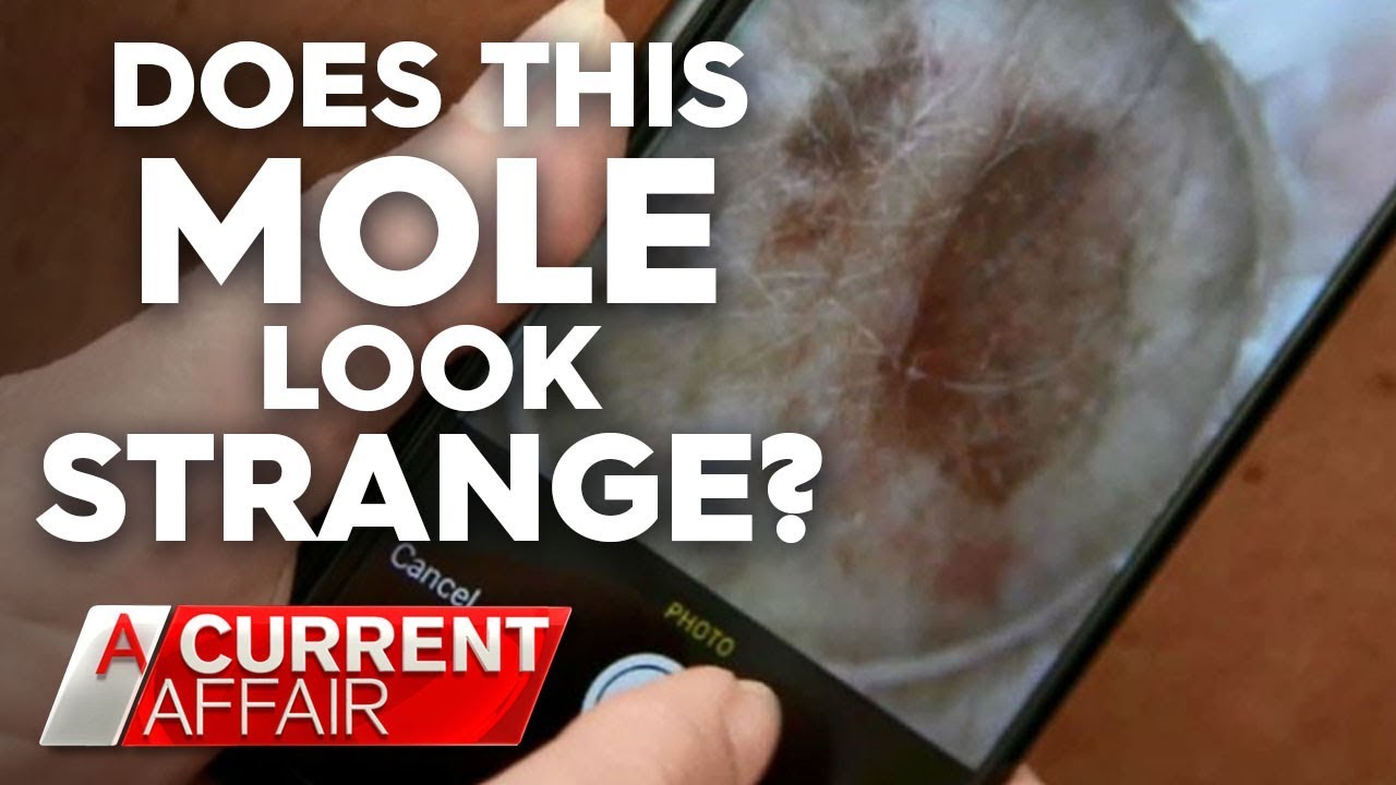 New way to help diagnose dangerous moles | A Current Affair