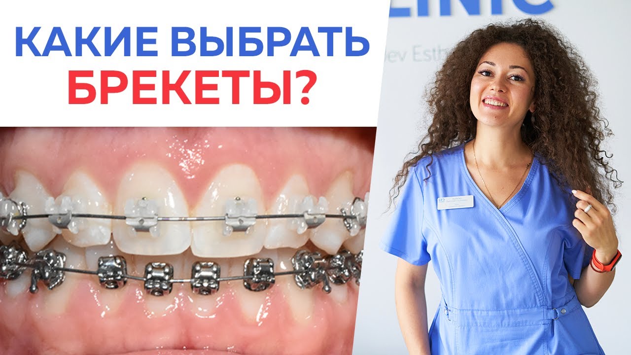 Какие брекеты выбрать? / Что лучше – металлические брекеты или керамические брекеты?