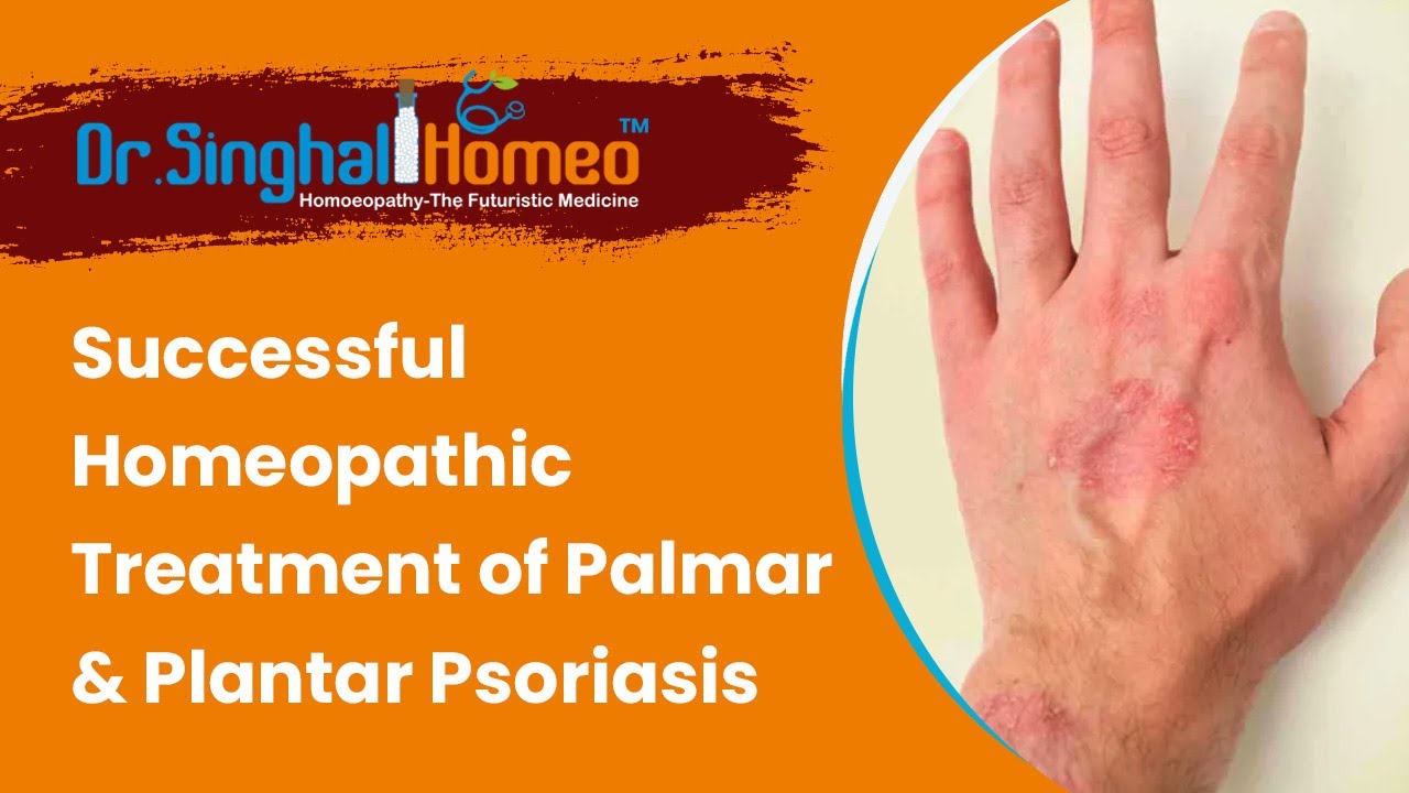 Critical Case of Palmar & Plantar Psoriasis Effectively Treated at Dr. Singhal Homeo, Chandigarh