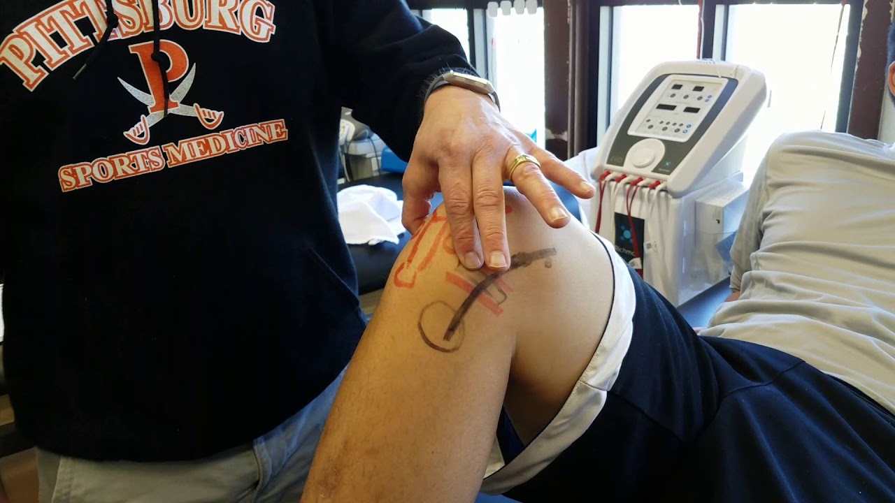 McMurray meniscus