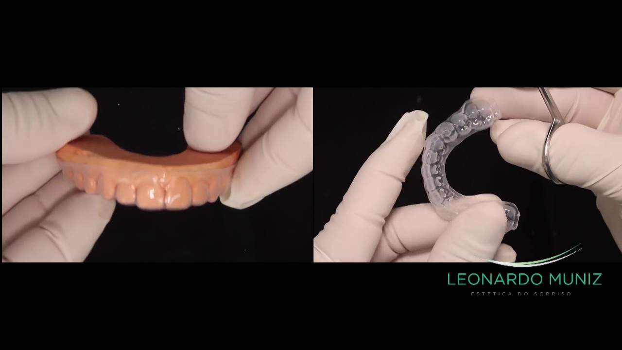 Clareamento  Dental. Técnicas