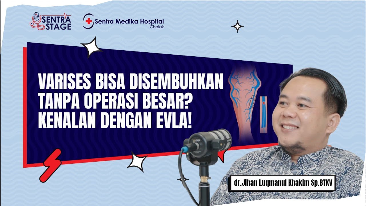 Varises Bisa Disembuhkan Tanpa Operasi Besar? Kenalan dengan EVLA! Sentra Stage