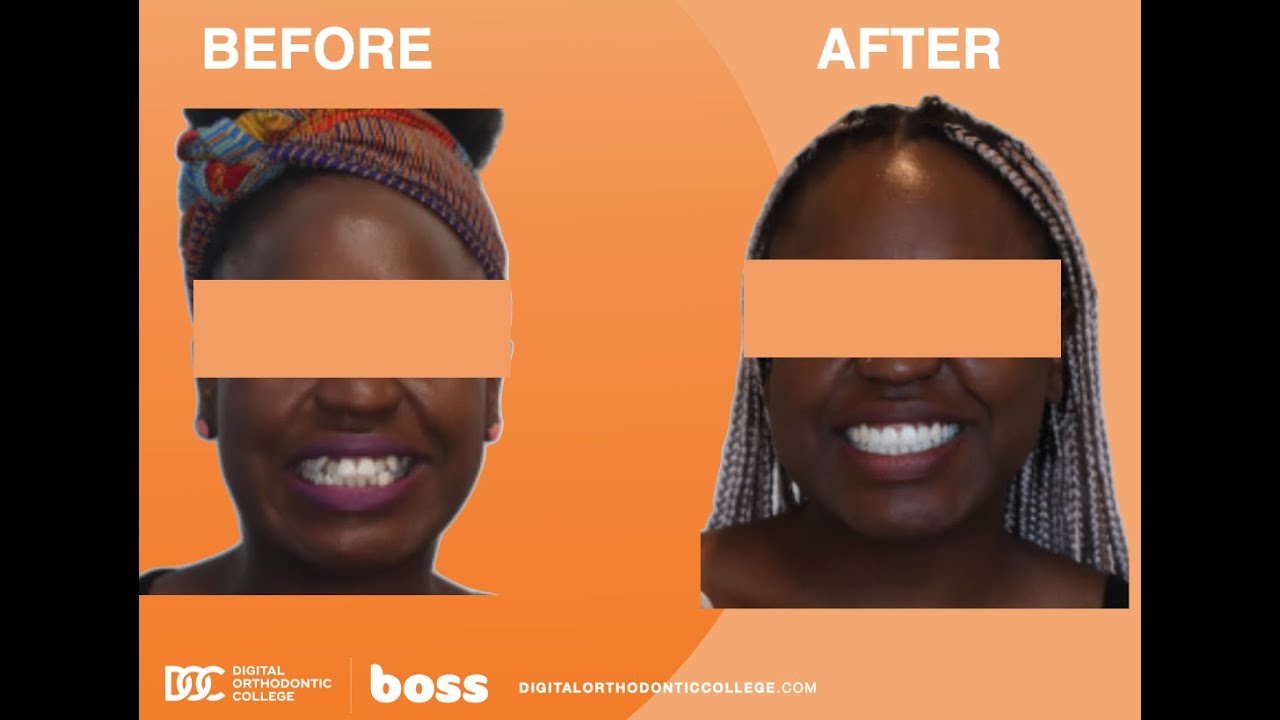 Invisalign Transformation! Severe Crowding and Protrusion treated without teeth extractions