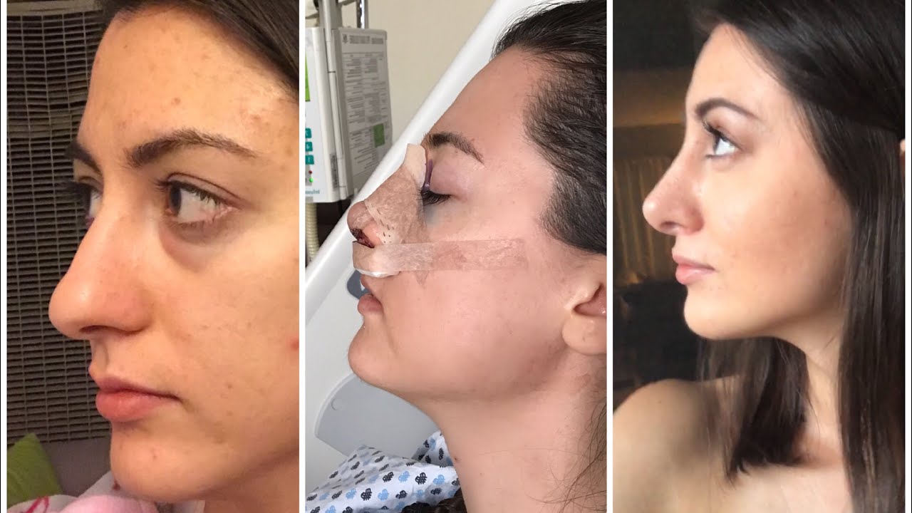 1- 6 months rhinoplasty update | month by month nose job  recovery|