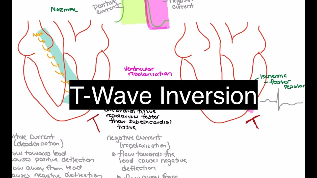 Ischemic T-Wave Inversion