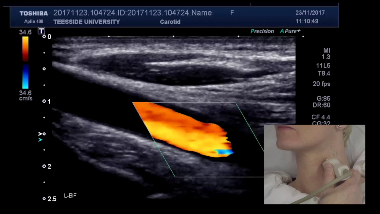 How to scan the carotid arteries