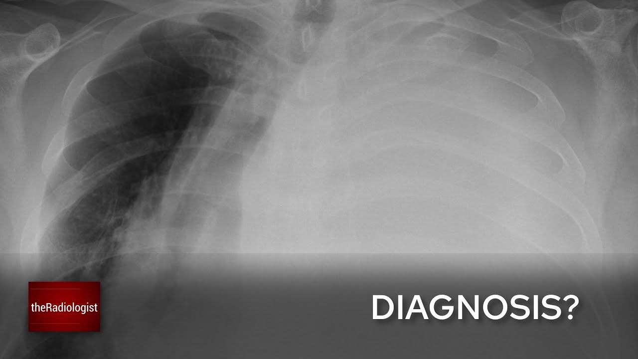 Case: how to tackle a white-out on Chest X-Ray