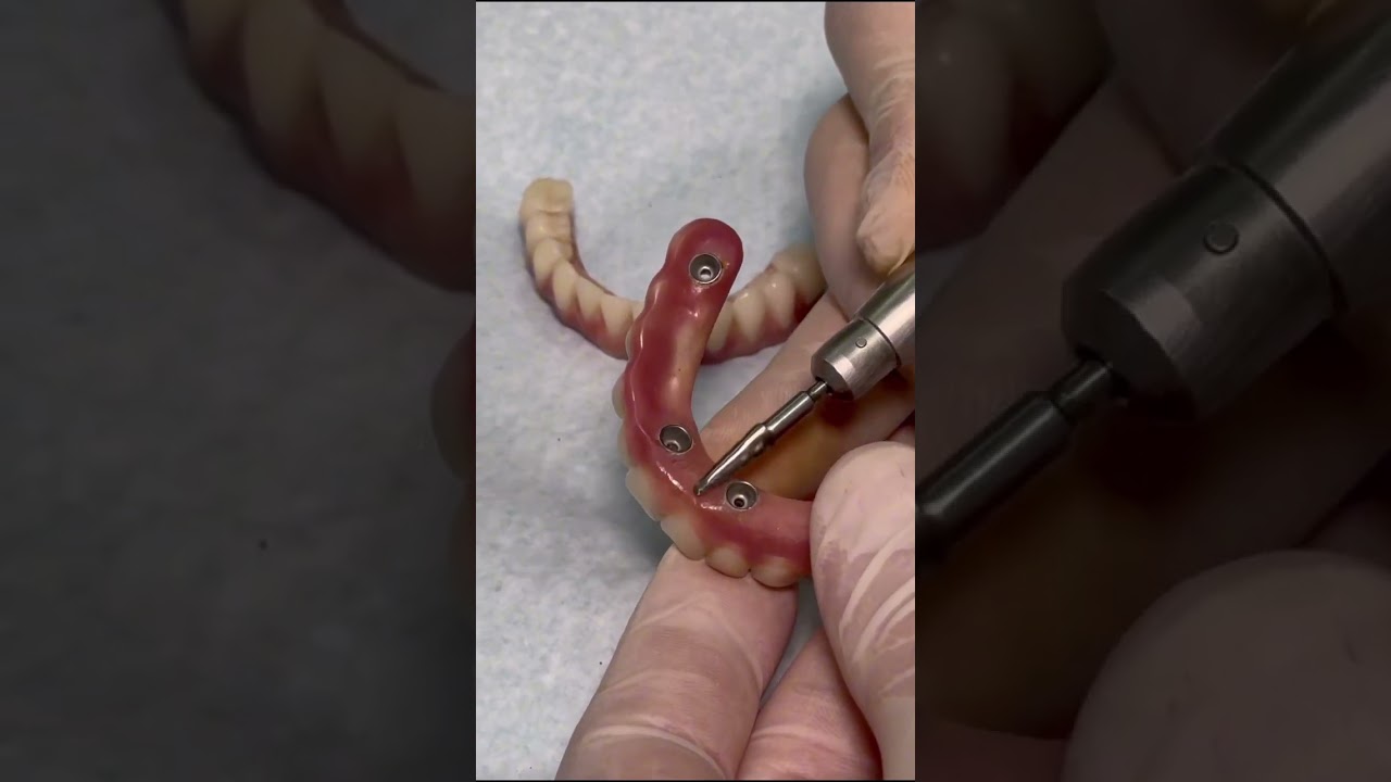 Manuten&ccedil;&atilde;o da pr&oacute;tese protocolo #protesedentaria #dentist #proteseprotocolo