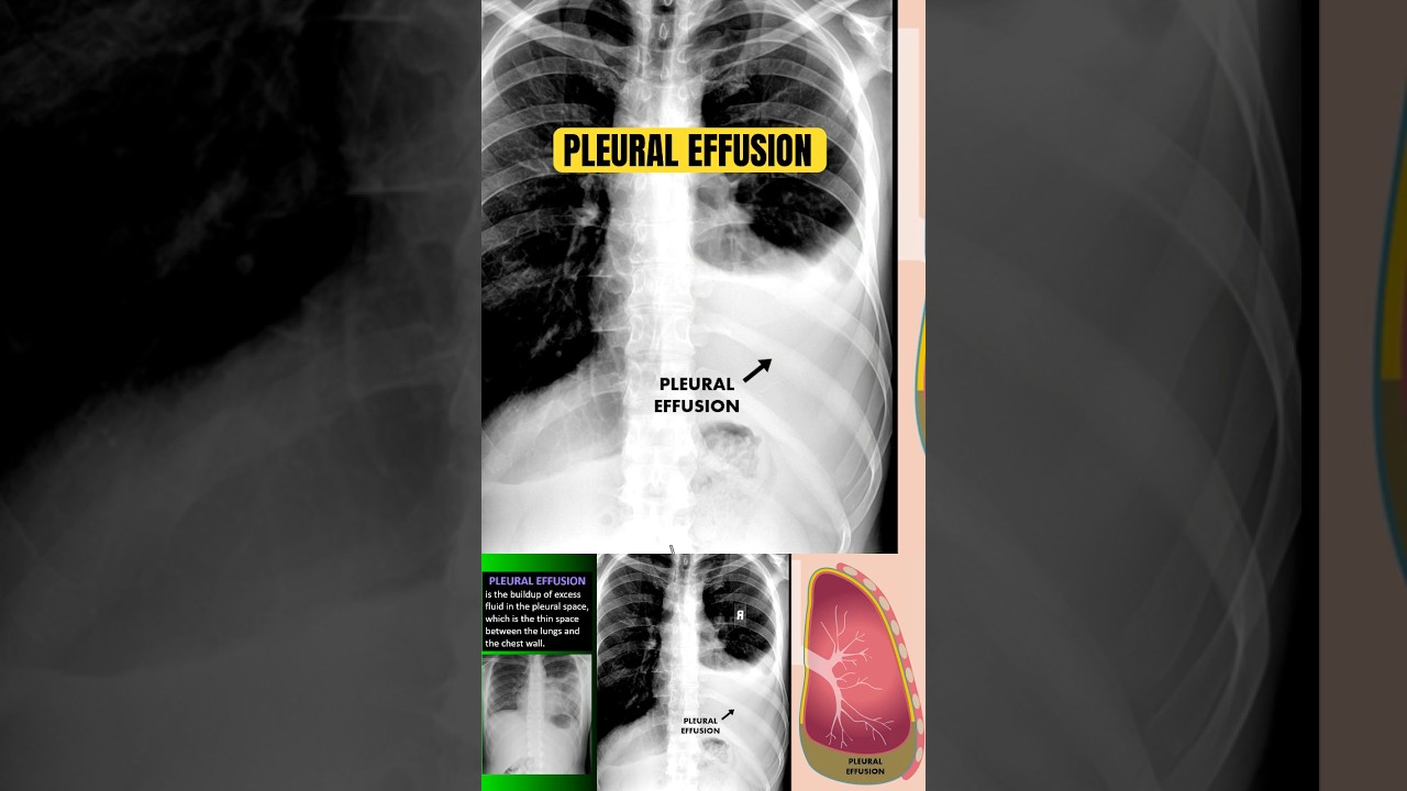Wyniki zdjęć rentgenowskich klatki piersiowej w zapaleniu płuc z wysiękiem opłucnowym 🩻 #spodenki #radiologia #klatka piersiowa #lekarz