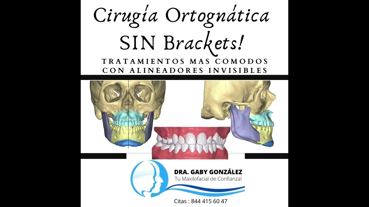 Cirug&iacute;a Ortogn&aacute;tica Saltillo / Dra. Gaby Gonz&aacute;lez Maxilofacial