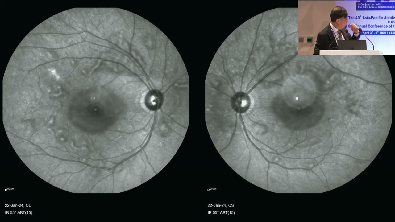 AIOS2025-IC1023-Mystery Retina Cases