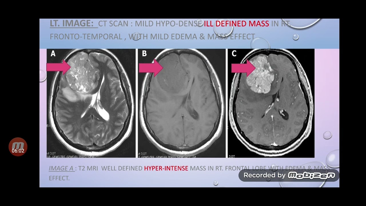 brain tumor