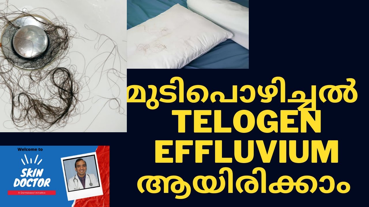 Hair fall/hair loss malayalam talk|മുടിപൊഴിച്ചൽ |hair fall due to telogen effluvium malayalam talk