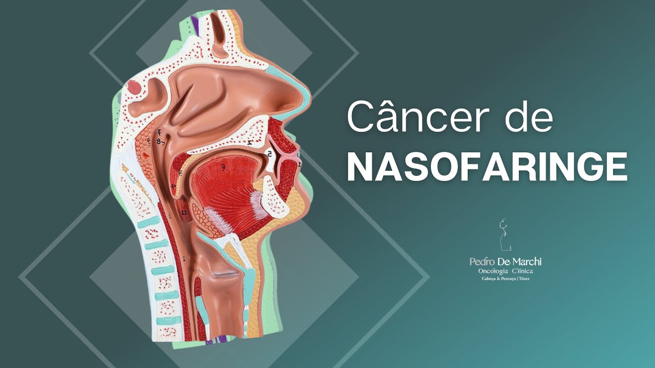 Câncer de Nasofaringe, você sabe o que é?