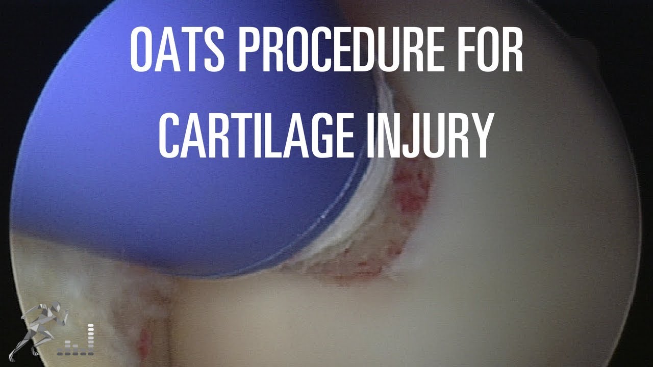 Cartilage injury and surgery: Osteochondral transfer