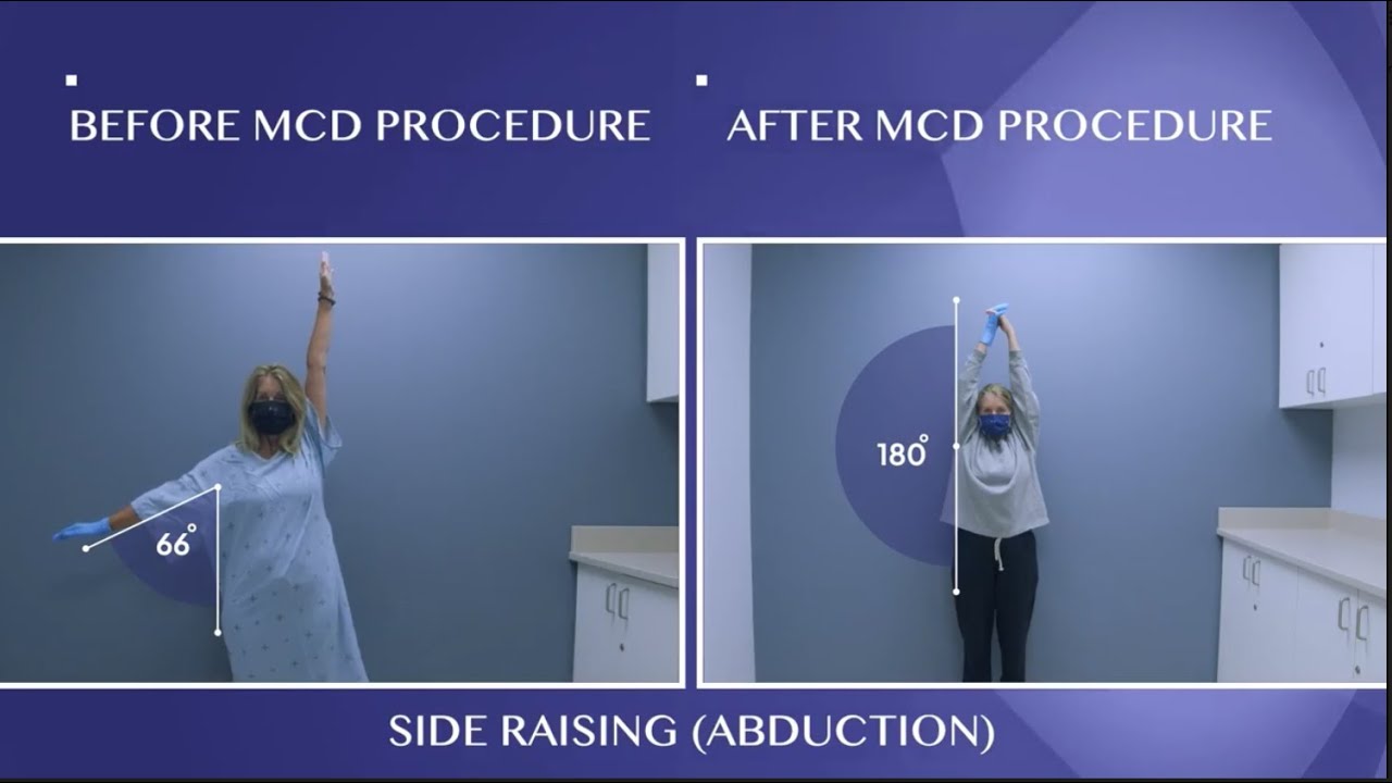 Patient's Frozen Shoulder Cured!