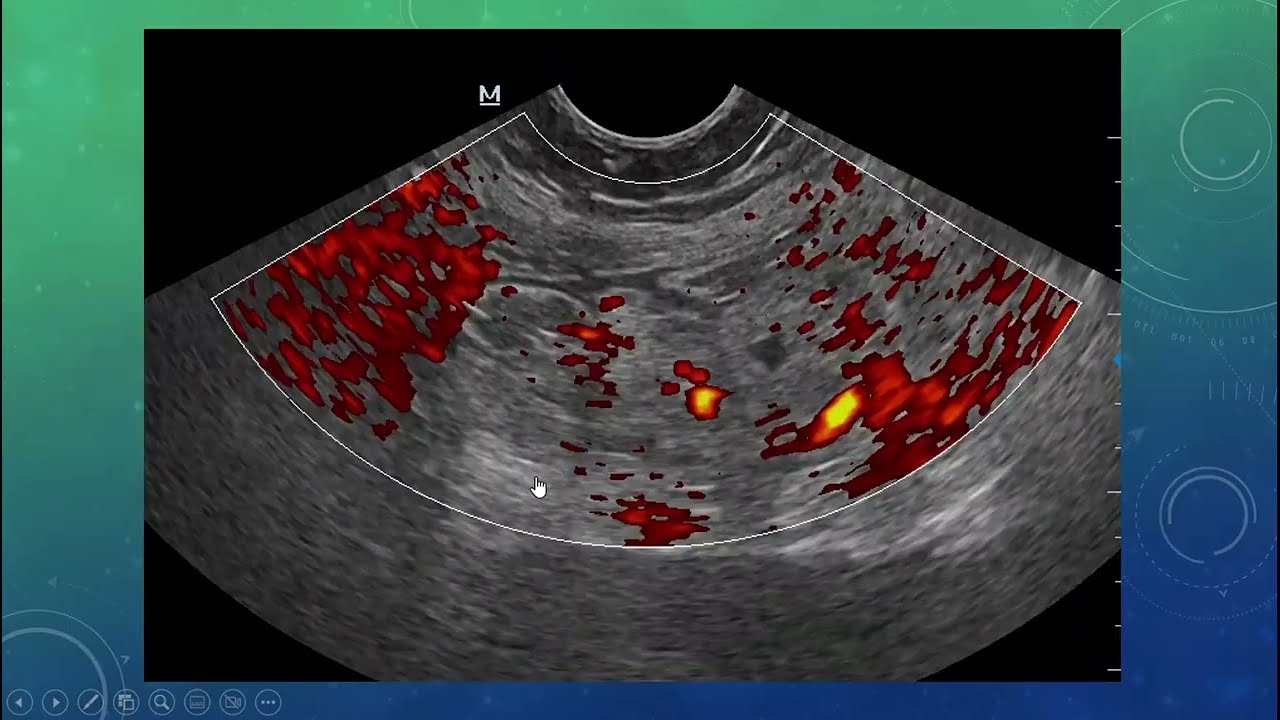 APENDICITIS CON COMPLICACION A PLASTRON APENDICULAR