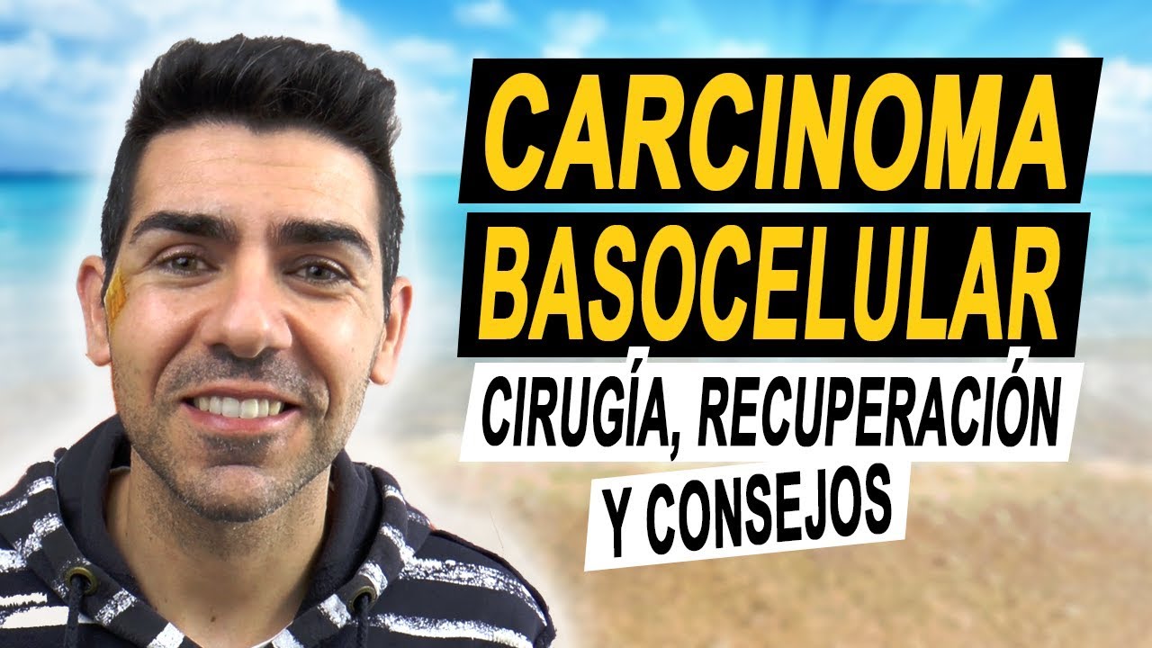 CARCINOMA BASOCELULAR | Operación, recuperación y consejos tras tener un carcinoma basal en la cara.