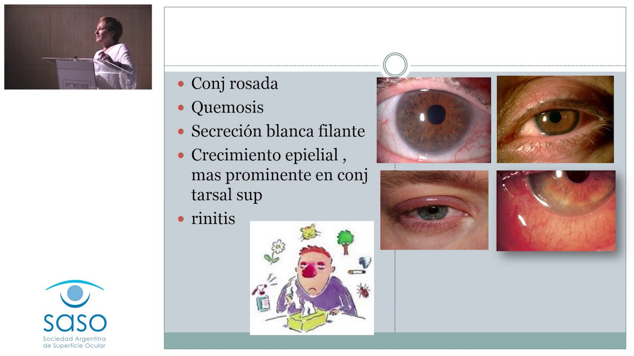 Conjuntivas Alérgicas - Dra Liliana Abuin