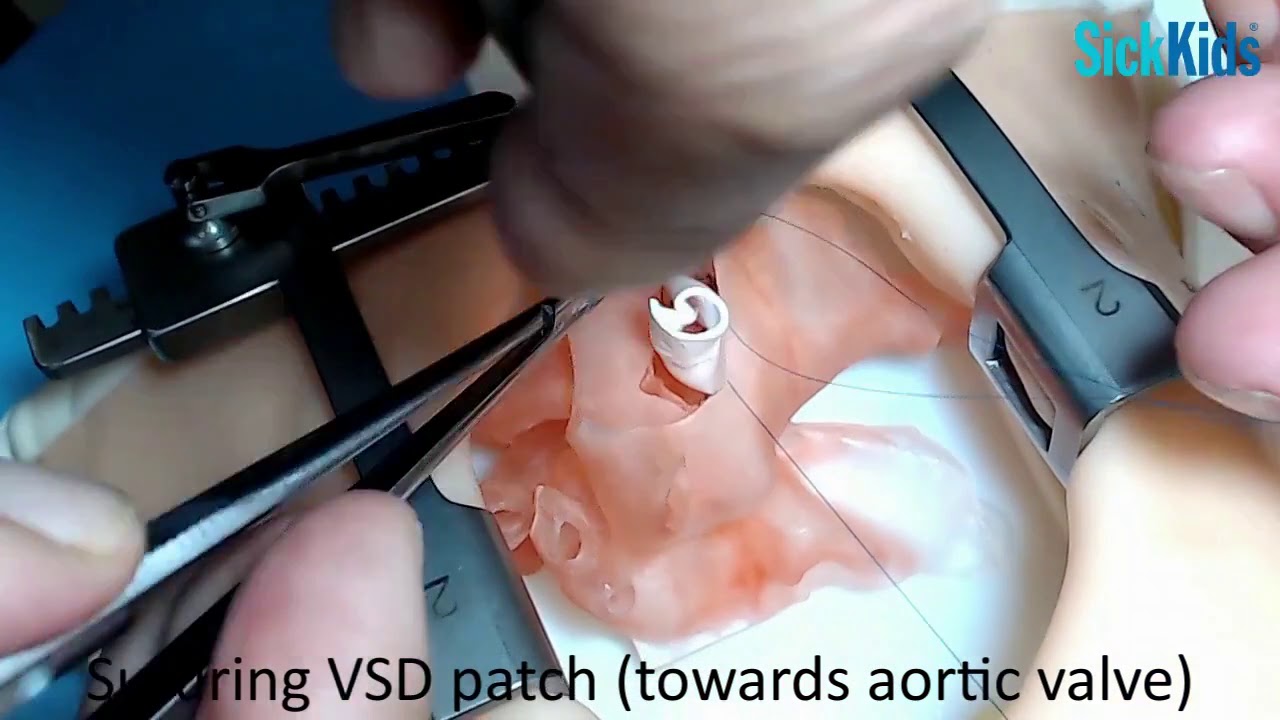 HOST - Double Outlet Right Ventricle (DORV) with Sub-aortic VSD repair on 3D model - Dr Osami Honjo