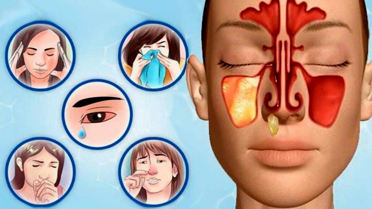ГАЙМАРИТ КАСАЛИГИНИ УЙ ШАРОИТИДА ДАВОЛАШ