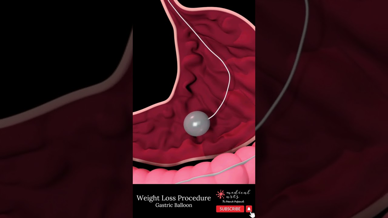 GASTRIC BALLOON [] bariatric surgery [] weight loss surgery #shorts