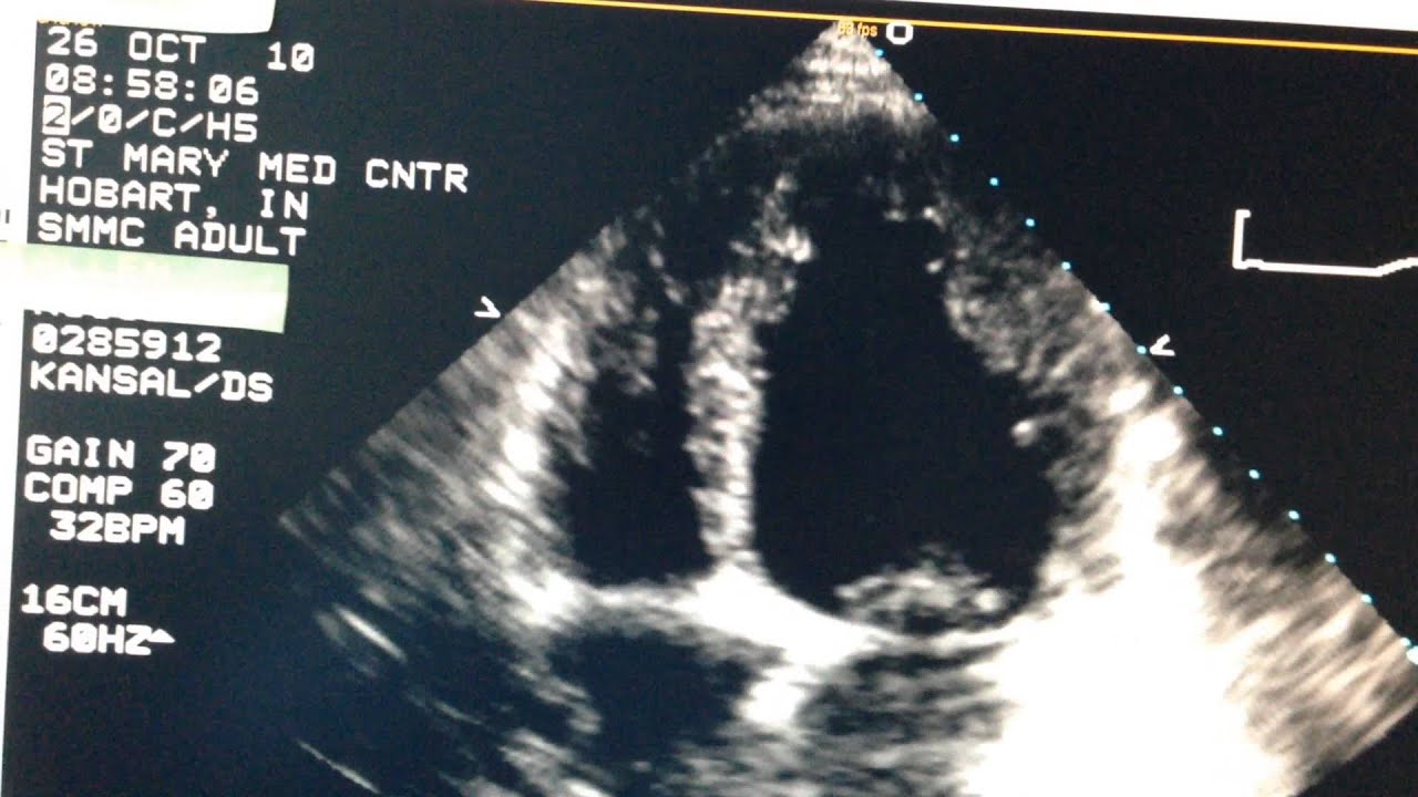 How Stem Cells Help a Dying Heart - Cardiomyopathy!!!!