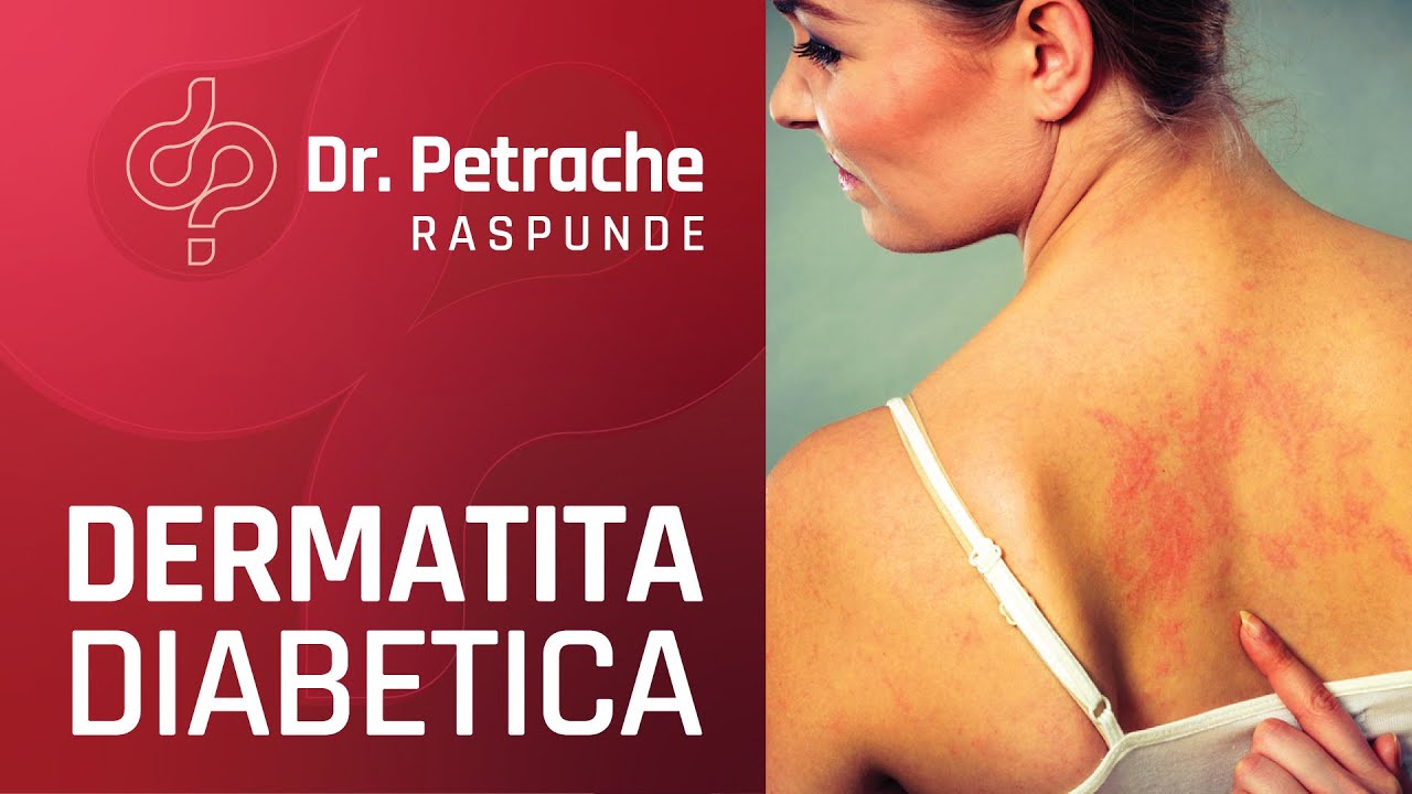 Ce este dermatita diabetica?