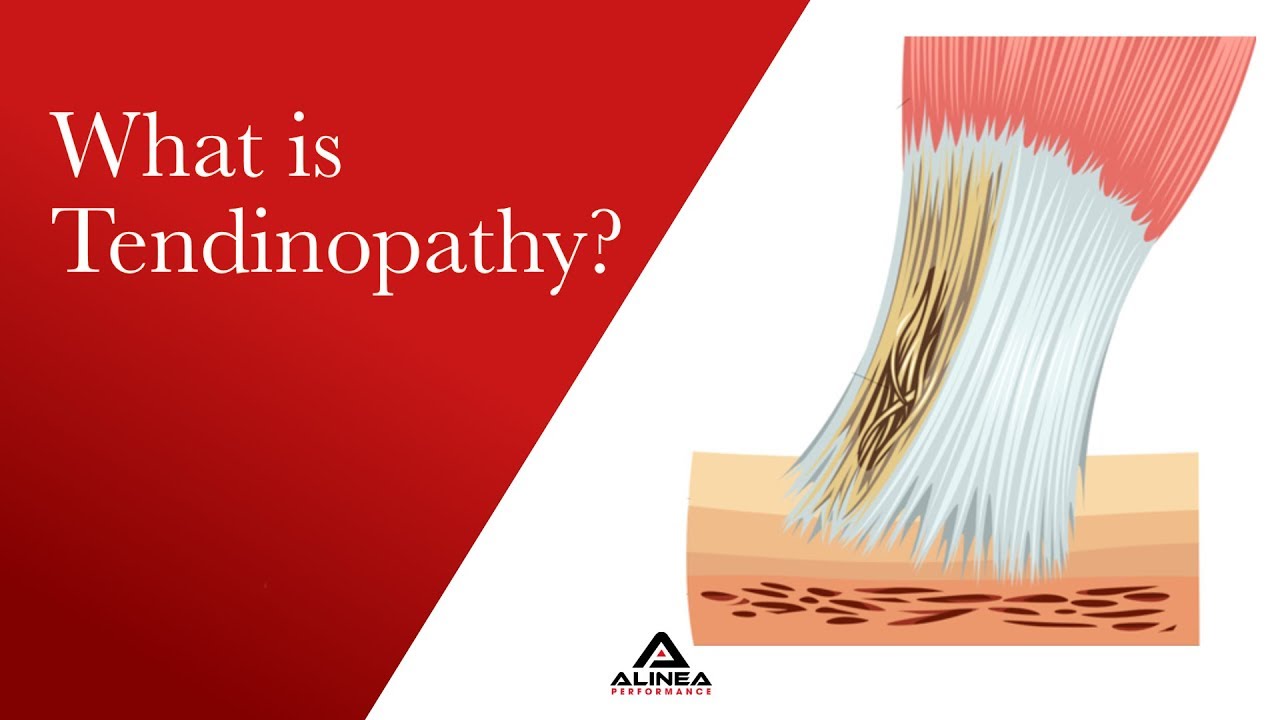 What is Tendinopathy?