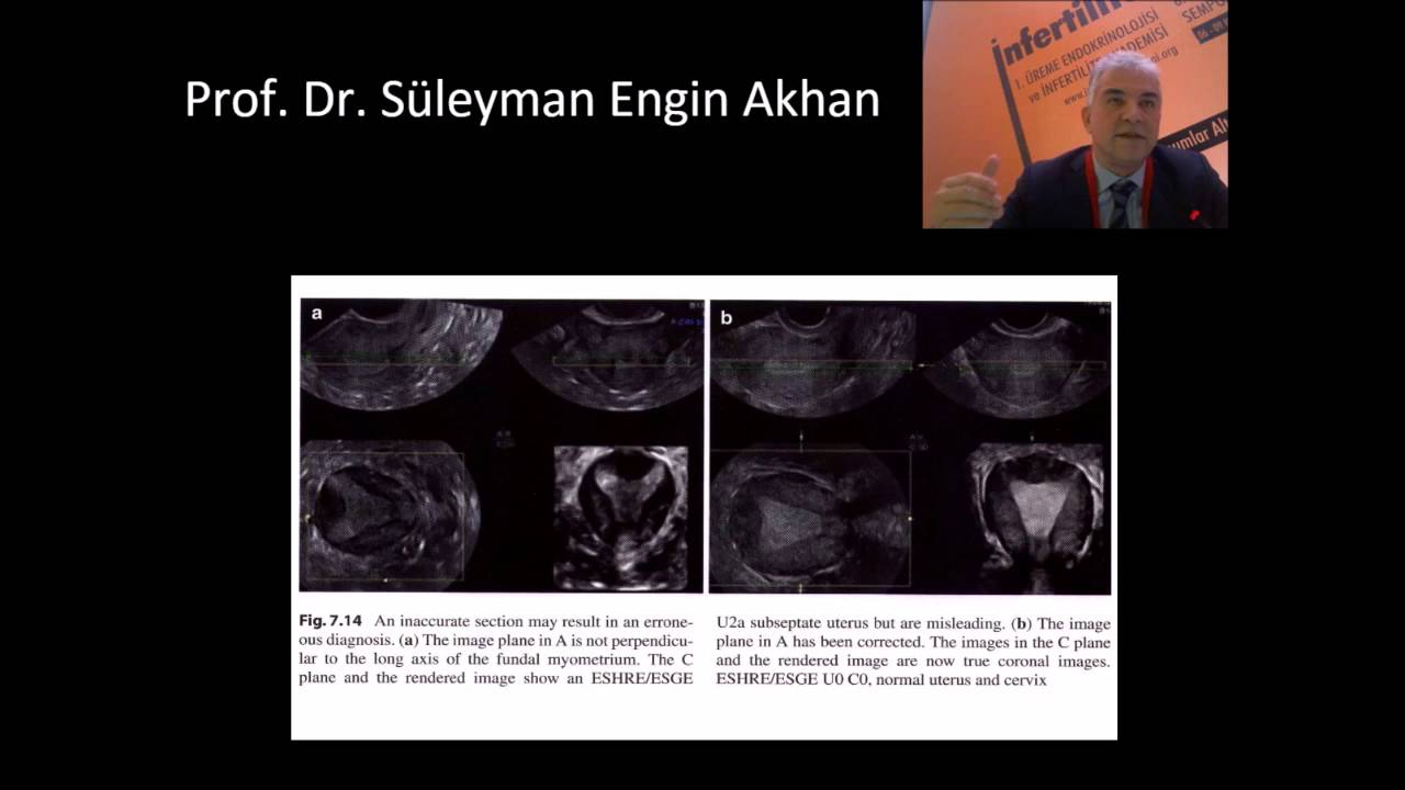 Konjenital Uterus Anomalileri (Doğuştan Rahim Anormallikleri) -Prof. Dr. S&uuml;leyman Engin Akhan